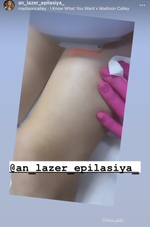 an-lazer-epilasiya-aynure-zeynalova-big-2
